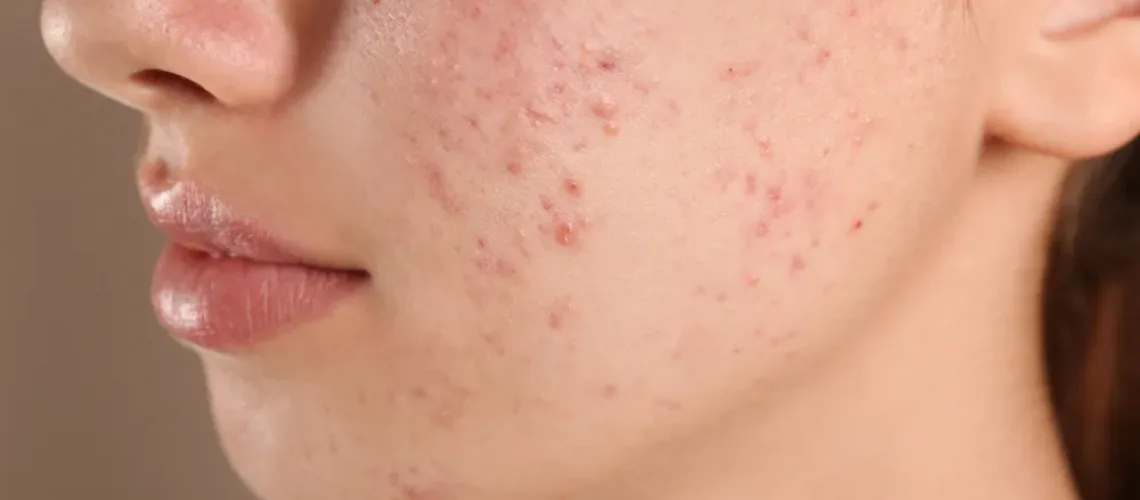 online acne consultation